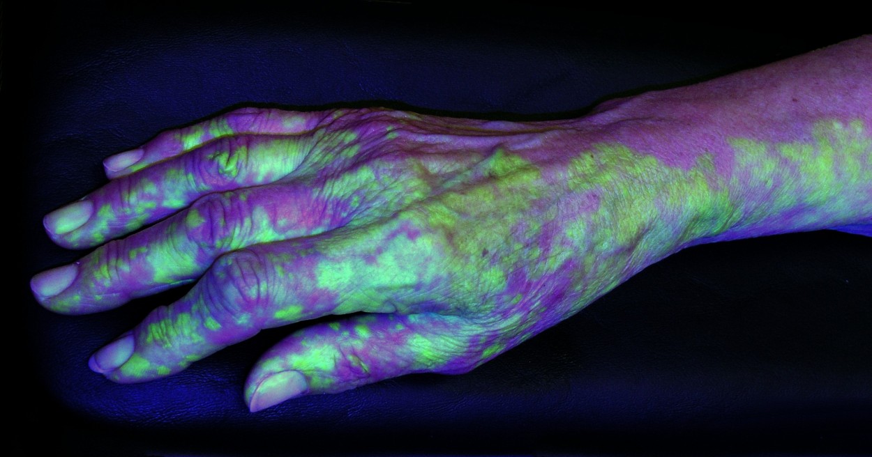 Fundamentals of Fluorescein EYEPIX